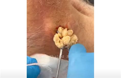 Massive Creamy Neck Cyst Drainage - New Pimple Popping Videos