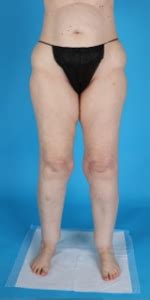 Lipedema before and after photos of Lipedema surgery results.