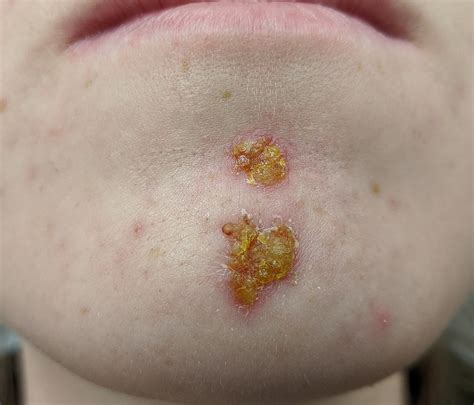 Impetigo | Geeky Medics