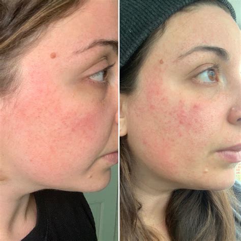 groin area herpetic folliculitis pictures 3
