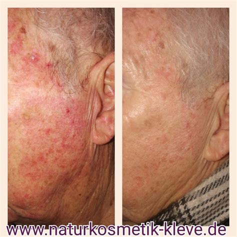Mezotix ® in Bedburg-Hau bei Naturkosmetikerin Susanne Kaußen