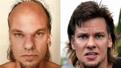 Theo Von Hair Transplant: Procedure, Results & Insights - Hermest Clinic