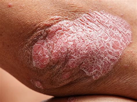 Locations and Types of Psoriasis: What to Know