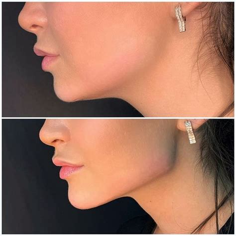 ultimate guide  face lifting    surgical option