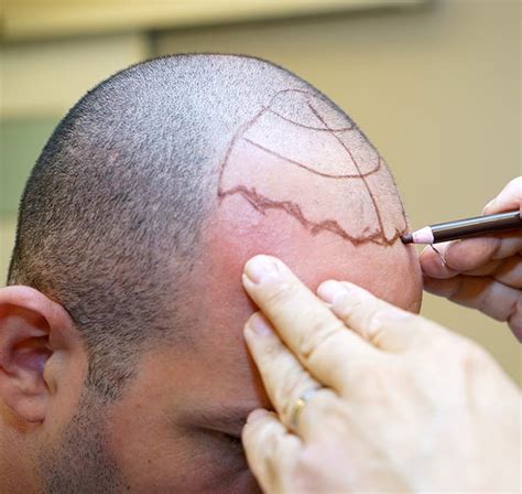 truth  hair transplant techniques davis hair