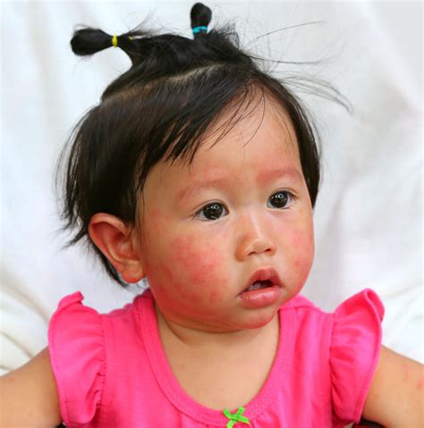 Atopische Dermatitis - Die besten Behandlungsmethoden | NEW MOM