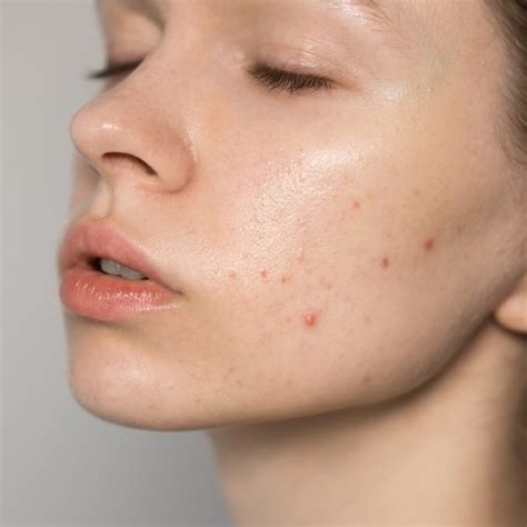 The Truth Behind Why Acne Keep Coming – Context Skin