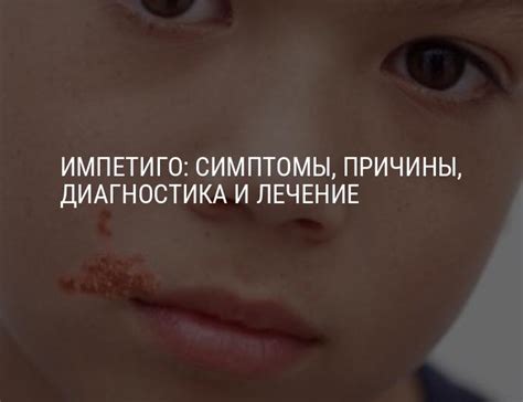 Импетиго: симптомы, причины, методы диагностики и лечения импетиго