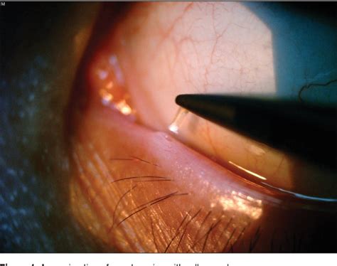 Figure 1 from Can lacrimal punctum size link to the severity of dry eye ...