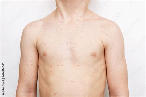 cropped shot   child   red rash   body isolated