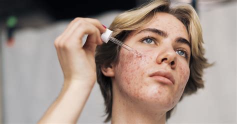 how to get rid of under the skin pimples fast 11