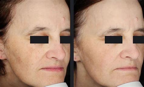 patient hyperpigmentation treatment candela medical
