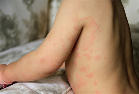 What Does A Viral Rash Look Like - Infoupdate.org