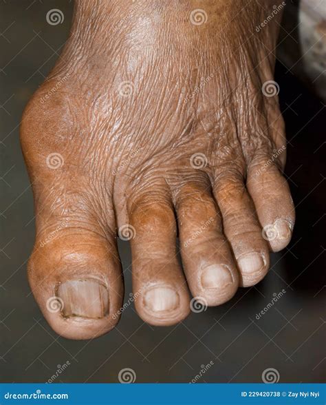Foot Dislocation Is Resulting In Severe Pain, Swelling And Numbness Of