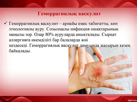 Клиникалық тәжірибедегі гематологиялық синдромдар - презентация онлайн