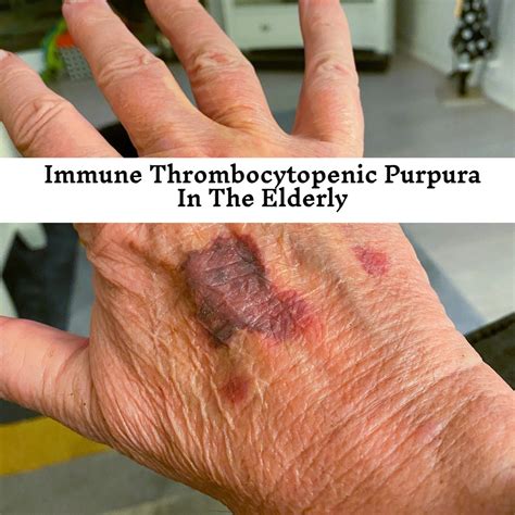immune thrombocytopenic purpura   elderly ezinsure