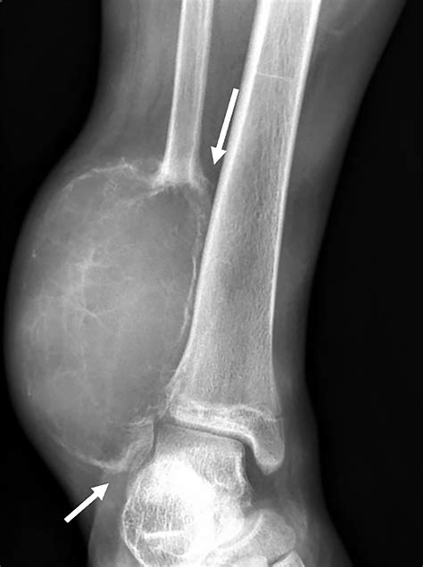 AppliedRadiology on Twitter: "Diagnosis ⏩Aneurysmal bone cyst. Differential diagnosis includes ...