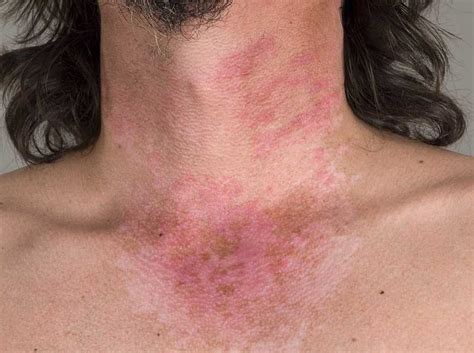 lupus skin rash pictures - pictures, photos