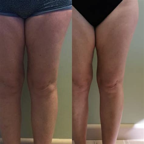 Before & After Gallery – Slim Me