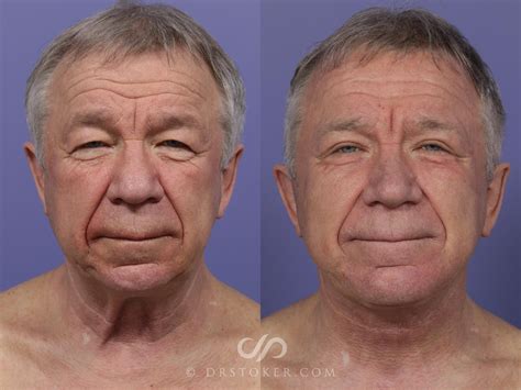 Neck Lift for Men Before and After Photo Gallery | Los Angeles, CA