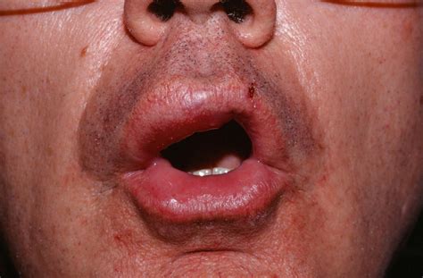 How To Treat Hives On Lips | Lipstutorial.org