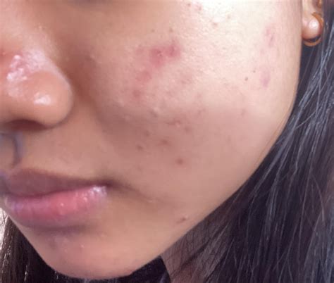 how to get rid of acne scarring 14