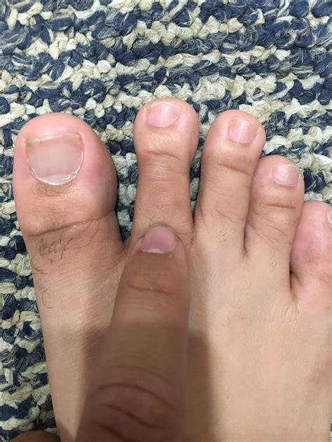 Been running again and my 2nd toe joint hurts : r/BarefootRunning