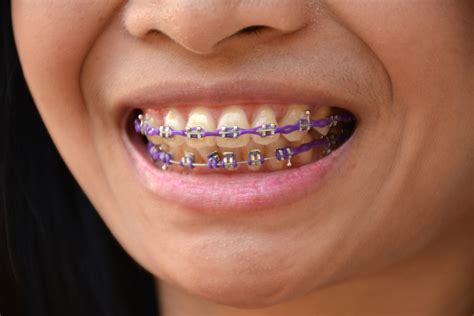 Power Chains in Braces: What They Are, How They Work, and Why They