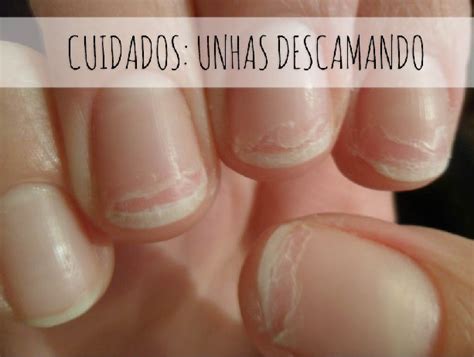 Unha Descamando - Minhas unhas estão descamando! O que pode ser? | Atual FM