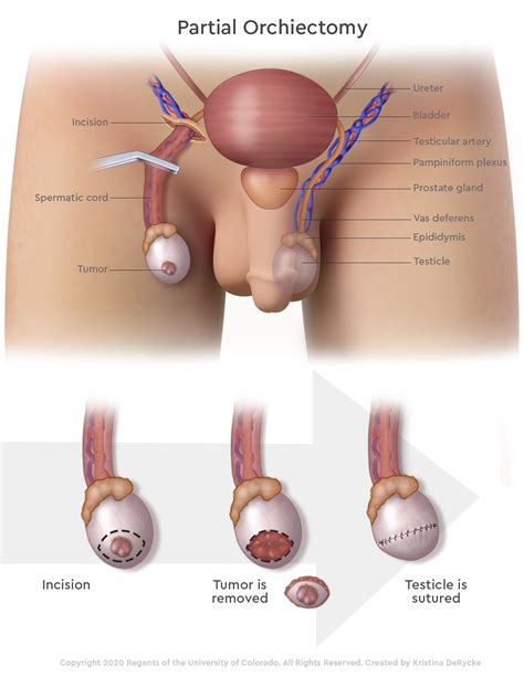 Orchiectomy Side Effects