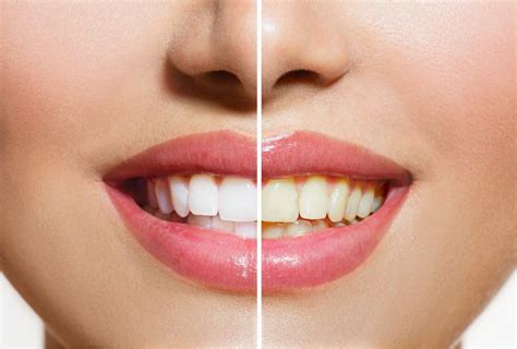 ways  naturally whiten  teeth  damaging  enamel
