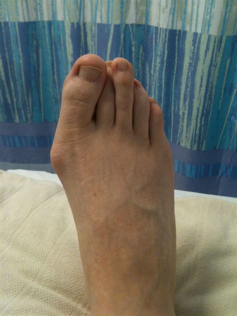 Everyday Rainbows: Post-op Bunion operation picture (look away if