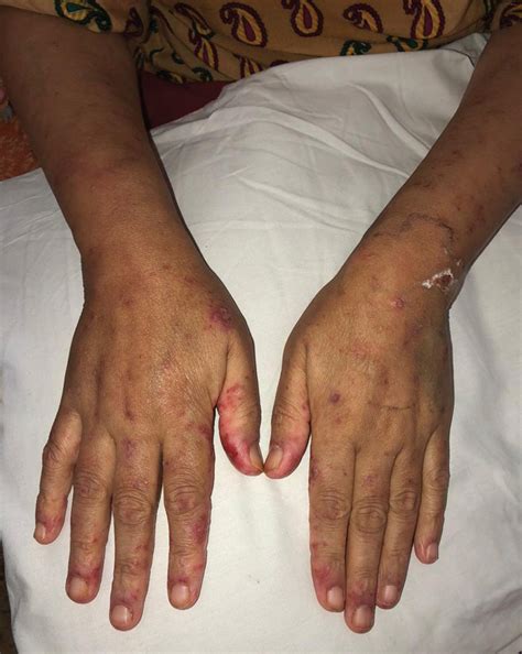 Lupus Rash On Hands Skin Papules, Hand Neuropathy And Monoclonal