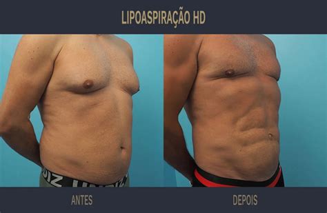 Gordura Na Axila Antes E Depois - Lipo Gordura Axila Antes E Depois - Livros