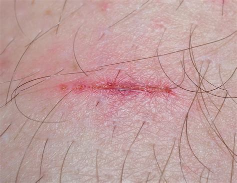 400+ Free Wound & Bandage Images - Pixabay