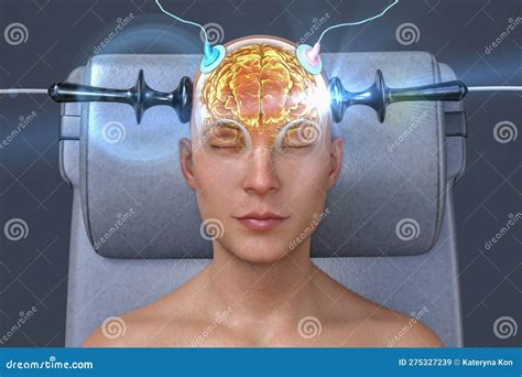 Electroconvulsive Therapy, ECT, a Treatment Involving the Use of ...
