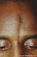 Morphea - American Osteopathic College of Dermatology (AOCD)