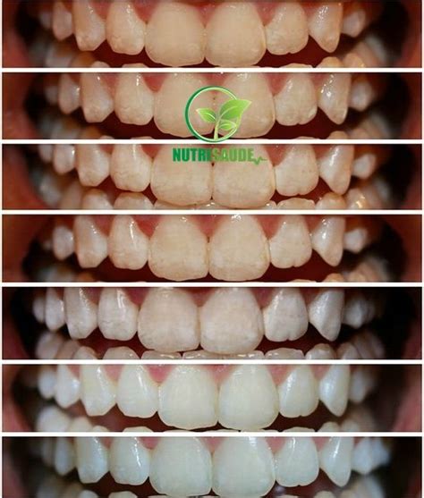 O Que Clareia Os Dentes - Passe Isso Para Clarear os Dentes na Primeira Aplicação! Que tal uma ...