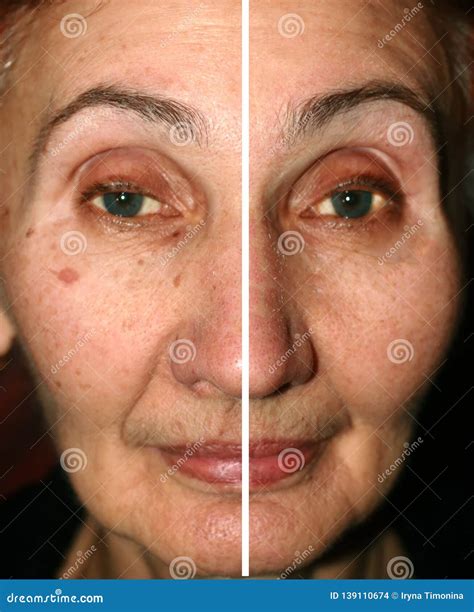 Pigmentation On The Face. Brown Spot On Cheek. Pigment Spot On The Skin