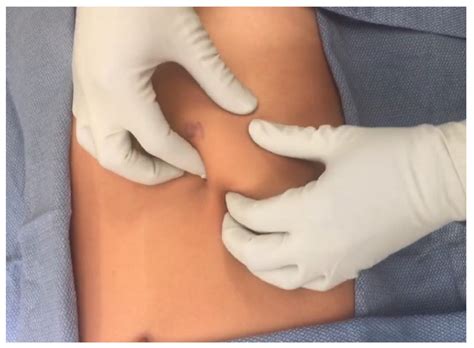 A Review of Slipping Rib Syndrome: Diagnostic and Treatment Updates to