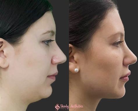 Jawline Fillers - Before & After Results at Skinly