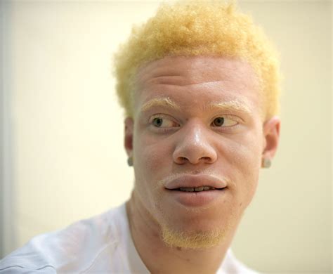 Albino Black Person