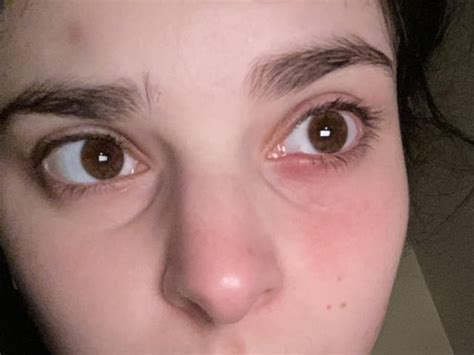 Some time and some hot compresses later. I am in hell : r/popping