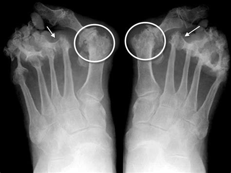 Rheumatoid Arthritis X Ray Foot