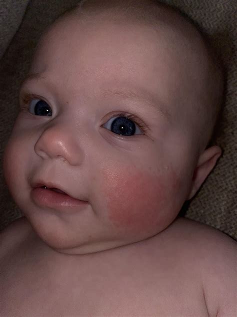 Redness On Babys Cheeks