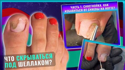 Что скрываться под шеллаком? Часть 1. Синегнойка. Как избавиться от ...