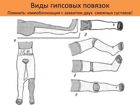 Принципы и современные методы лечения переломов. Несросшиеся переломы ...
