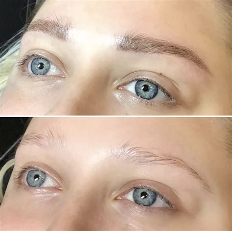 how does a tattoo removal work 5
