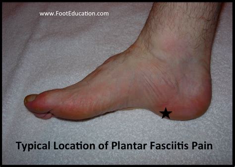 Plantar fasciitis - NedhalDarsi