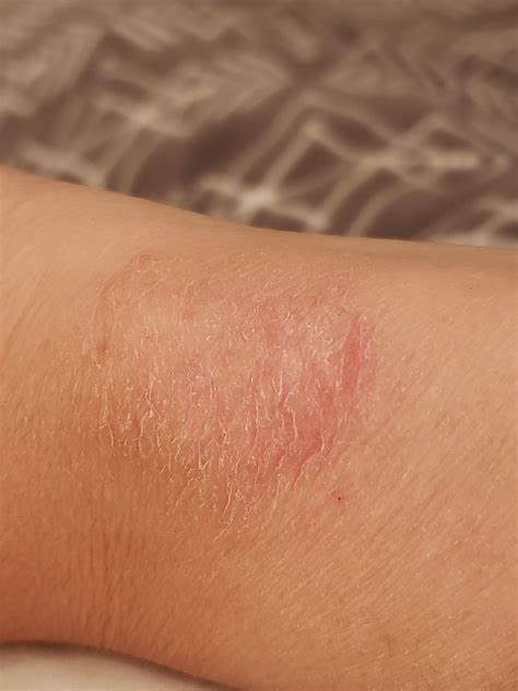 Samsung Galaxy Watch Rash : r/GalaxyWatch